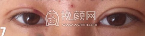 铜雀台徐敦小切口双眼皮+开眼角