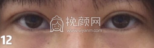 铜雀台徐敦小切口双眼皮+开眼角