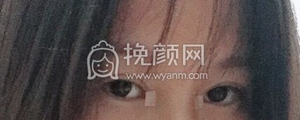 铜雀台徐敦小切口双眼皮+开眼角