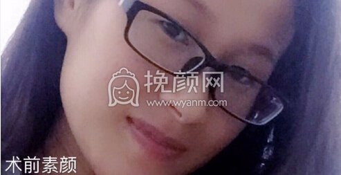 铜雀台徐敦小切口双眼皮+开眼角