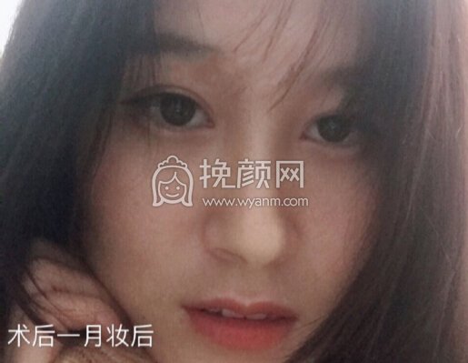 铜雀台徐敦小切口双眼皮+开眼角