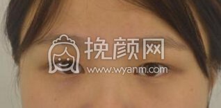 长沙伊美刘芳眼部手术(全切+内眼角+右眼提肌