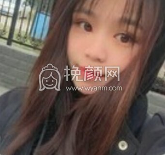 长沙伊美刘芳眼部手术(全切+内眼角+右眼提肌
