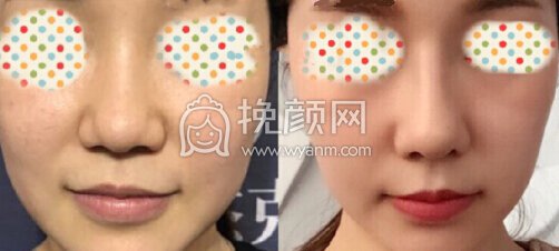南京东南大学附属中大医院郭宗科鼻部手术整形术