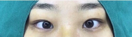福州优医联合王立敏重睑+去皮去脂+开眼角