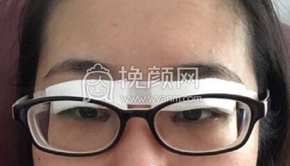 福州优医联合王立敏重睑+去皮去脂+开眼角