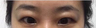 福州优医联合王立敏重睑+去皮去脂+开眼角