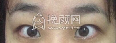 福州优医联合王立敏重睑+去皮去脂+开眼角