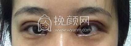 福州优医联合王立敏重睑+去皮去脂+开眼角