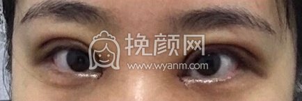 福州优医联合王立敏重睑+去皮去脂+开眼角