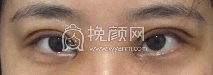 福州优医联合王立敏重睑+去皮去脂+开眼角