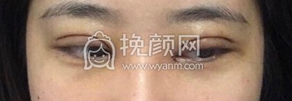 福州优医联合王立敏重睑+去皮去脂+开眼角