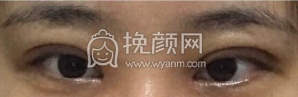福州优医联合王立敏重睑+去皮去脂+开眼角