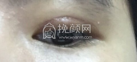 厦门中医院卢艺朴医生全切双眼皮+抽脂