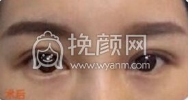 上海杨亚益做的双眼皮,开眼角+提肌
