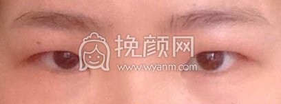 武汉同济医院曹玮医生全切双眼皮+开内眦