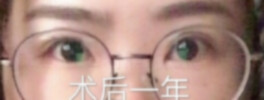 武汉同济医院曹玮医生全切双眼皮+开内眦