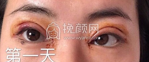 武汉爱思特杨主任做的全切+取线+修复+开眼角