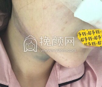 八大处尤建军全肋鼻部手术,吸双下巴,填太阳穴