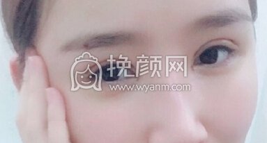 郑州望京医疗张鹏全脸填充,双眼皮和眼角修复