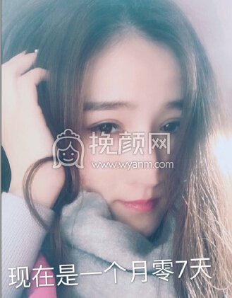 郑州望京医疗张鹏全脸填充,双眼皮和眼角修复