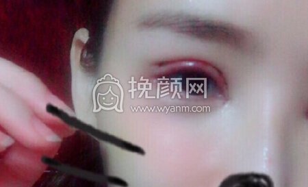 郑州望京医疗张鹏全脸填充,双眼皮和眼角修复