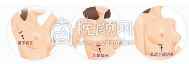 假体丰胸植入的假体没问题吗
