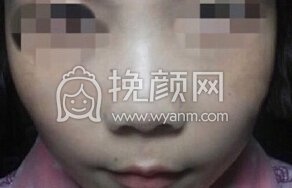 浙江绍兴鼻部手术修复