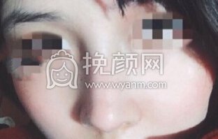 浙江绍兴鼻部手术修复