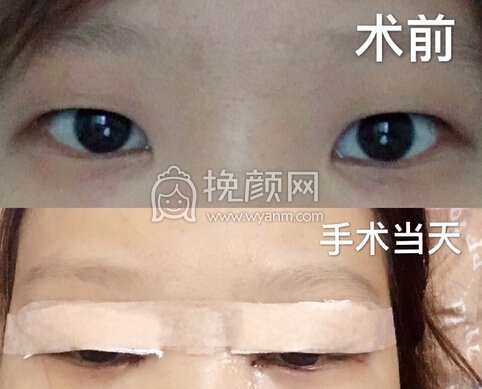 广州美莱美容田跃平全切+开眼角+上脸下垂