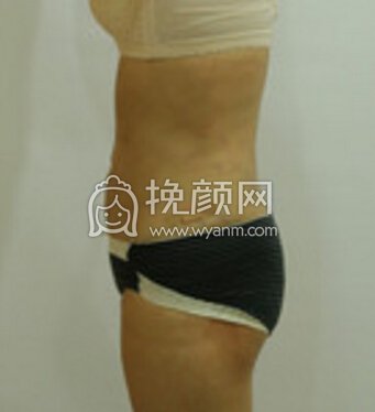 北京八大处齐越医生腰腹环吸+背部吸脂