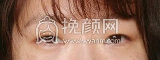 广州修志夫林戈亮医生眼部综合整形手术