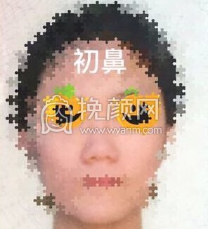 八大处平安里诊所杨欣面颊填充,硅胶修复