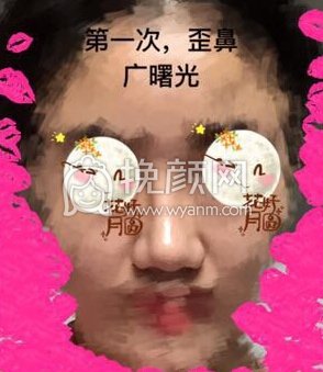 八大处平安里诊所杨欣面颊填充,硅胶修复