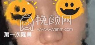 八大处平安里诊所杨欣面颊填充,硅胶修复