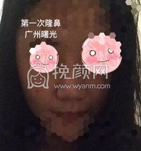 八大处平安里诊所杨欣面颊填充,硅胶修复