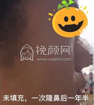 八大处平安里诊所杨欣面颊填充,硅胶修复