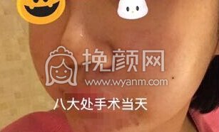 八大处平安里诊所杨欣面颊填充,硅胶修复