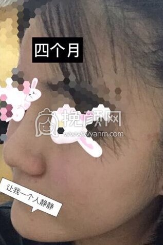 八大处平安里诊所杨欣面颊填充,硅胶修复