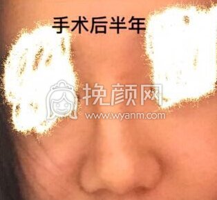八大处平安里诊所杨欣面颊填充,硅胶修复