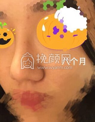 八大处平安里诊所杨欣面颊填充,硅胶修复