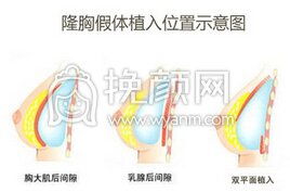 妙桃假体隆胸的果较为好吗?