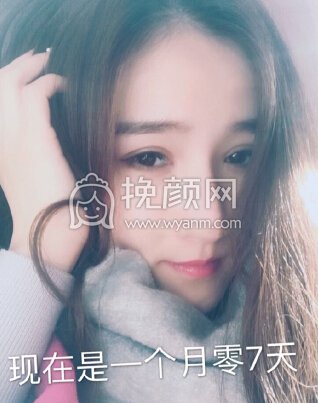 郑州望京医疗张鹏全脸填充,双眼皮眼角修复