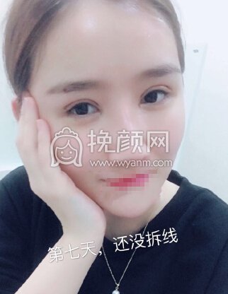 郑州望京医疗张鹏全脸填充,双眼皮眼角修复