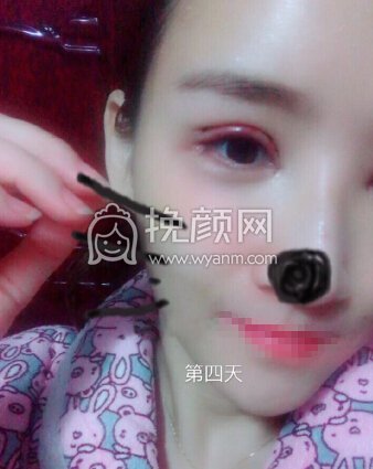 郑州望京医疗张鹏全脸填充,双眼皮眼角修复
