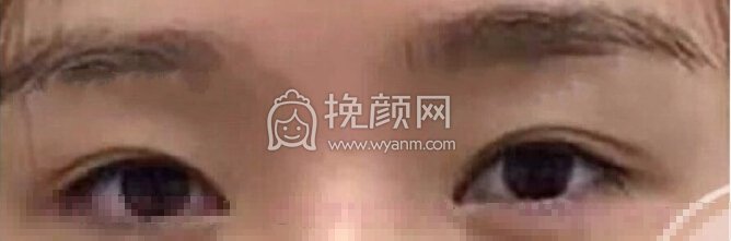 郑州望京医疗张鹏全脸填充,双眼皮眼角修复