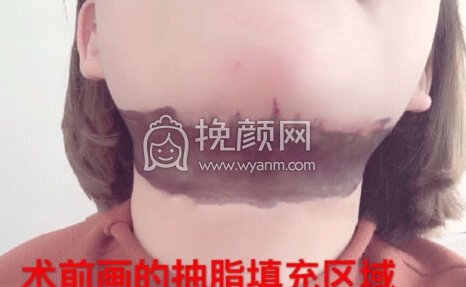八大处尤建军全肋隆鼻部手术,吸双下巴填太阳穴