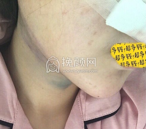八大处尤建军全肋隆鼻部手术,吸双下巴填太阳穴