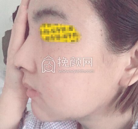 八大处尤建军全肋隆鼻部手术,吸双下巴填太阳穴