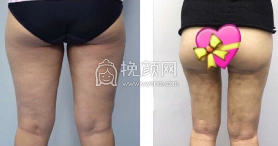 武汉思美妍美容医院客座教授田霞大腿环吸